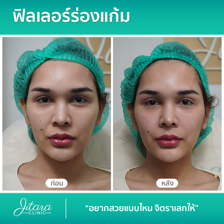 รีวิว ฟิลเลอร์ร่องแก้ม | jitaraclinic