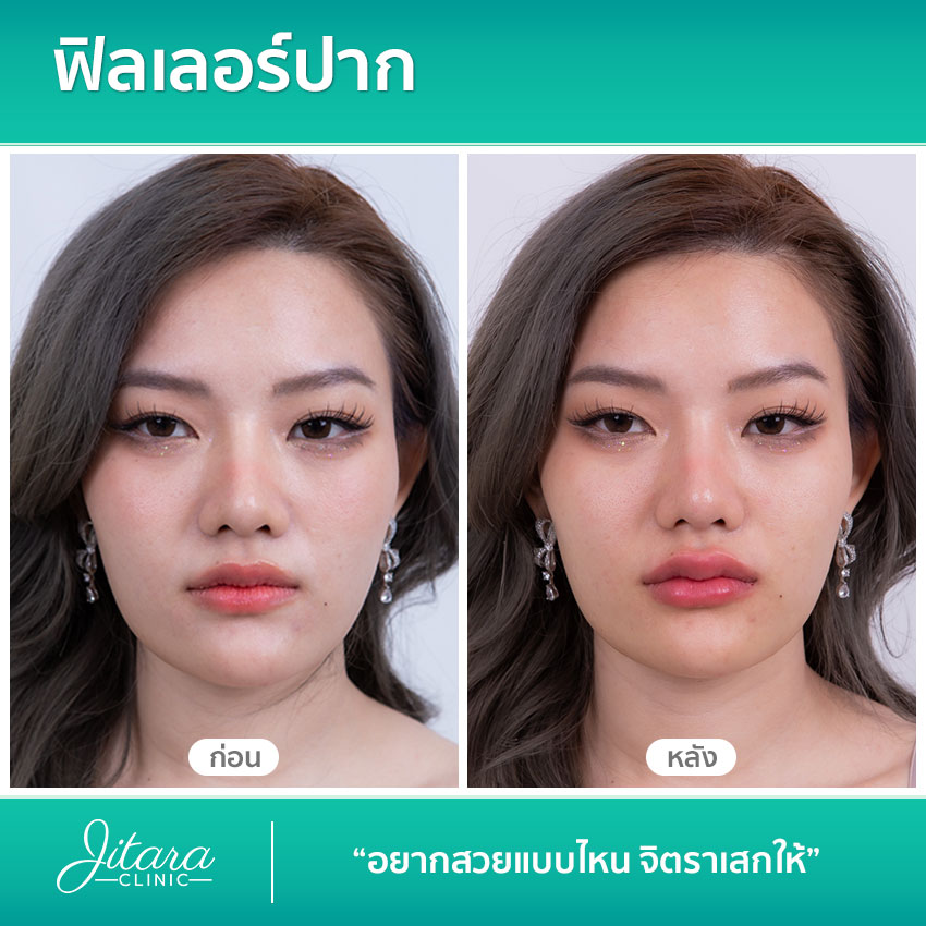 รีวิว ฟิลเลอร์ปาก