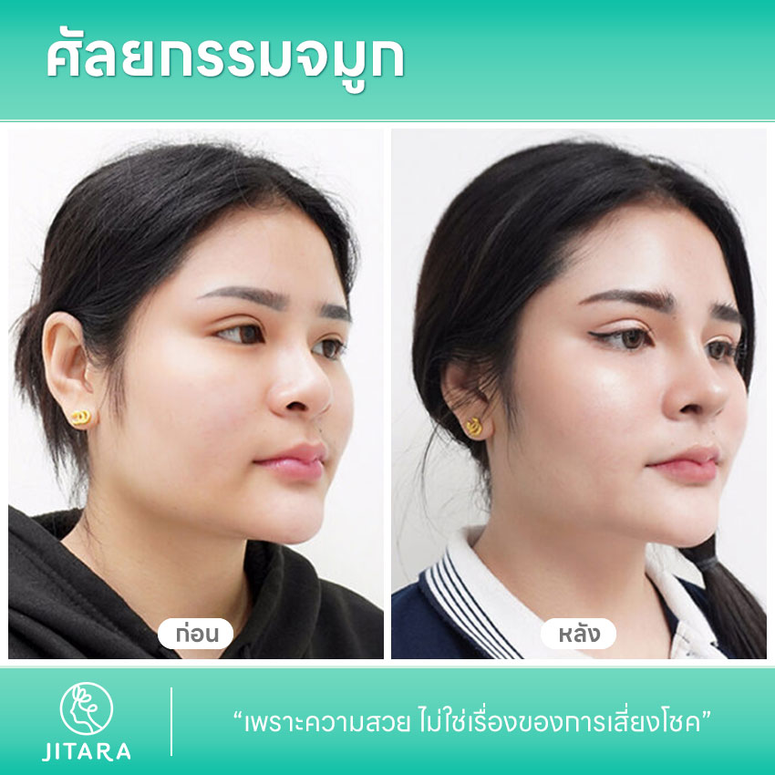 รีวิว เสริมจมูก