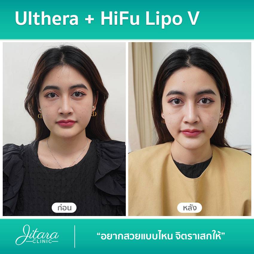 Ulthera + HiFu Lipo V