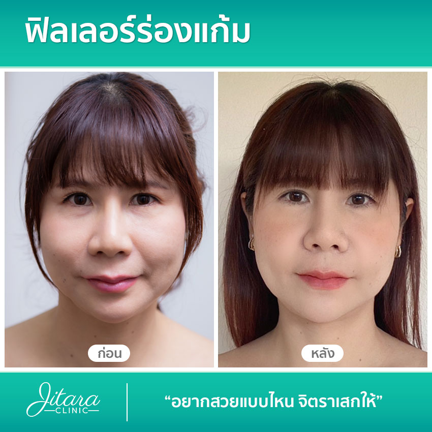 รีวิว ฟิลเลอร์ร่องแก้ม | jitaraclinic