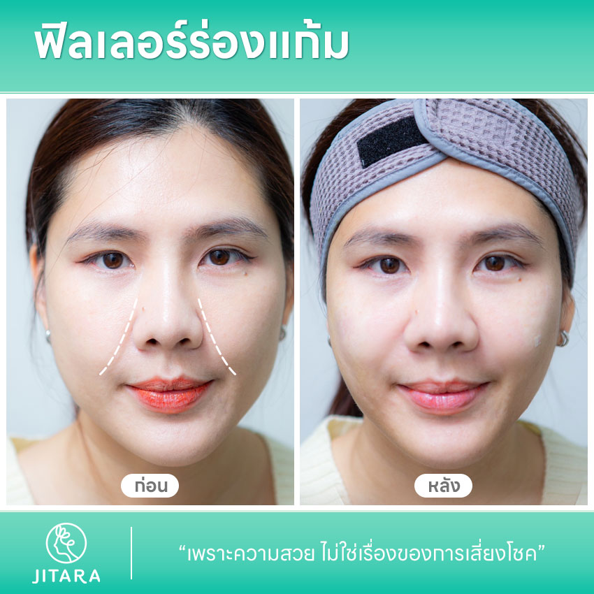 รีวิว ฟิลเลอร์ร่องแก้ม | jitaraclinic