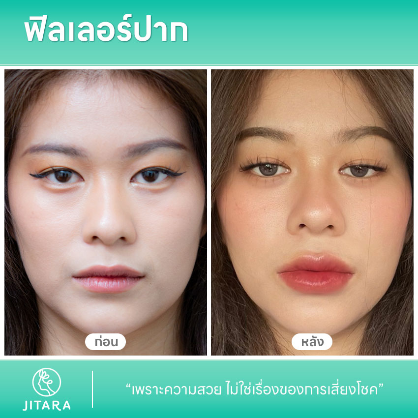 รีวิว ฟิลเลอร์ปาก | jitaraclinic