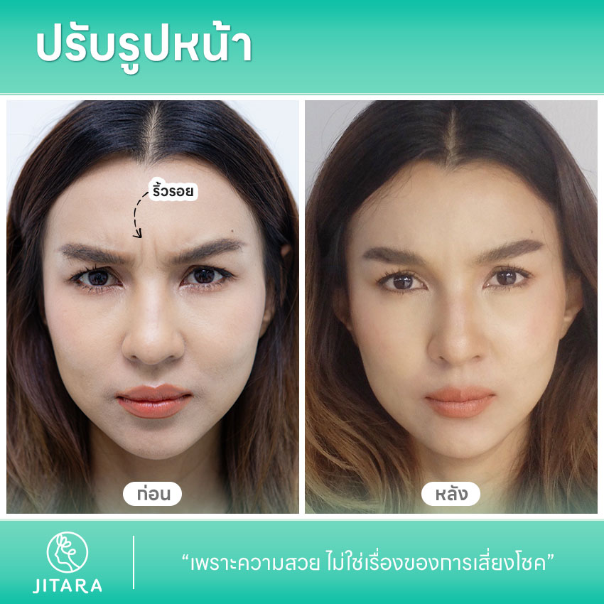 รีวิว การปรับรูปหน้า | jitaraclinic