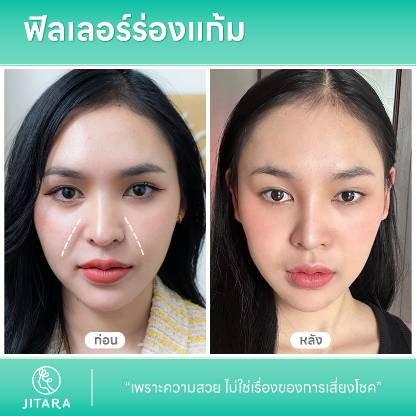 รีวิว ฟิลเลอร์ร่องแก้ม ที่ jitaraclinic