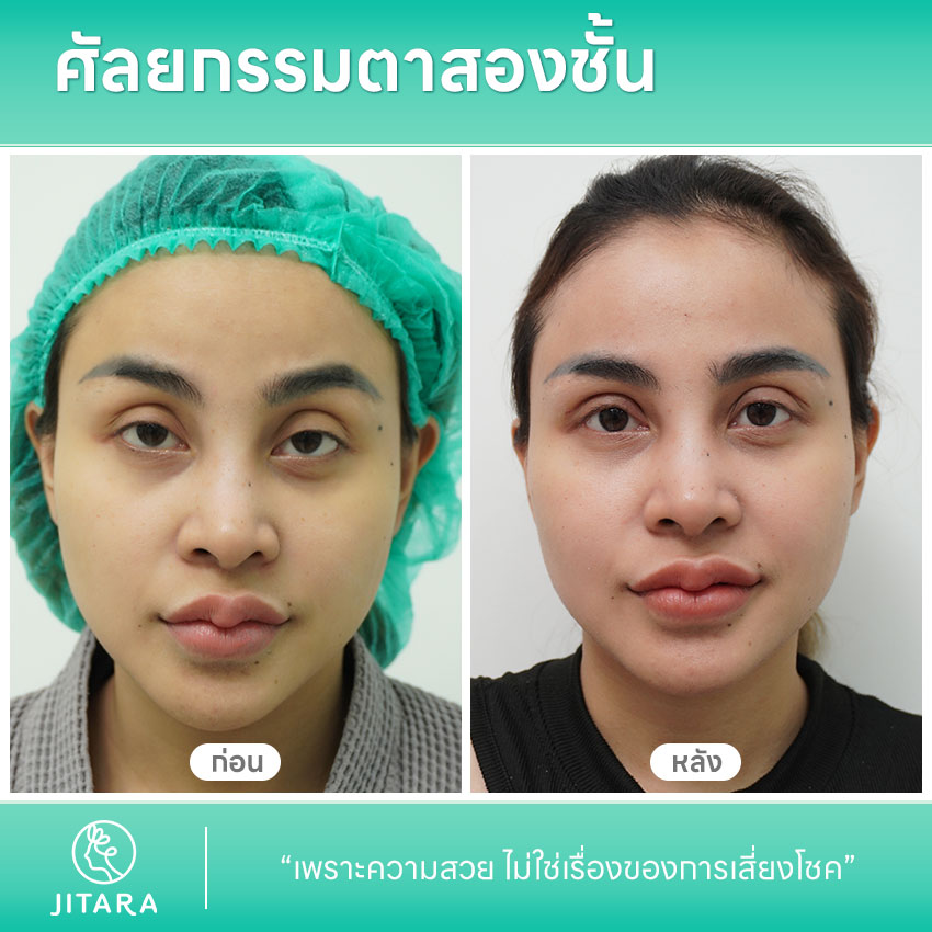 รีวิวทำ ศัลยกรรมตาสองชั้น