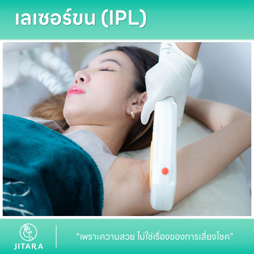 รีวิว เลเซอร์ขน (IPL)