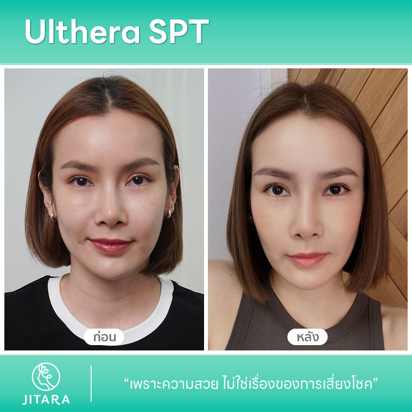 รีวิว Ulthera SPT