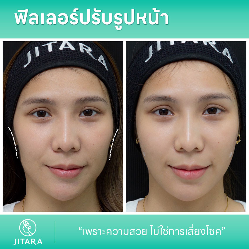 รีวิว ฉีดฟิลเลอร์ปรับรูปหน้า ศูนย์รวมศัลยกรรมสุขภาพ และความงามครบวงจร jitaraclinic