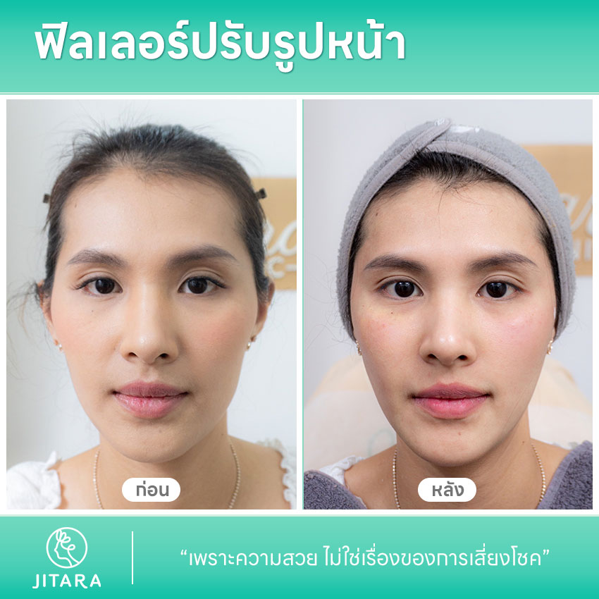 รีวิว ฉีดฟิลเลอร์ปรับรูปหน้า ศูนย์รวมศัลยกรรมสุขภาพ และความงามครบวงจร jitaraclinic