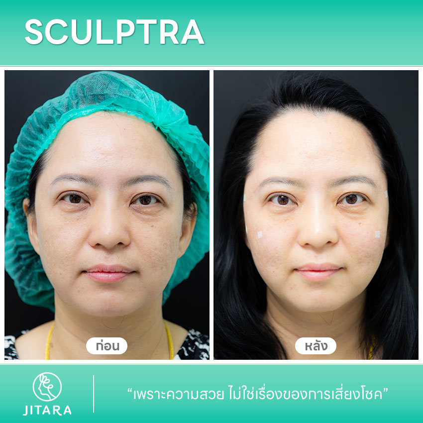 รีวิว Sculptra ศูนย์รวมศัลยกรรมสุขภาพ และความงามครบวงจร | jitaraclinic