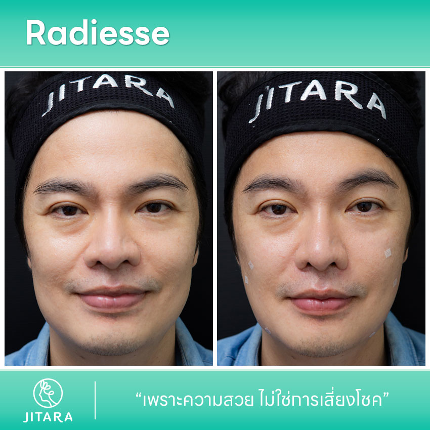 รีวิว Radiesse ที่ jitaraclinic