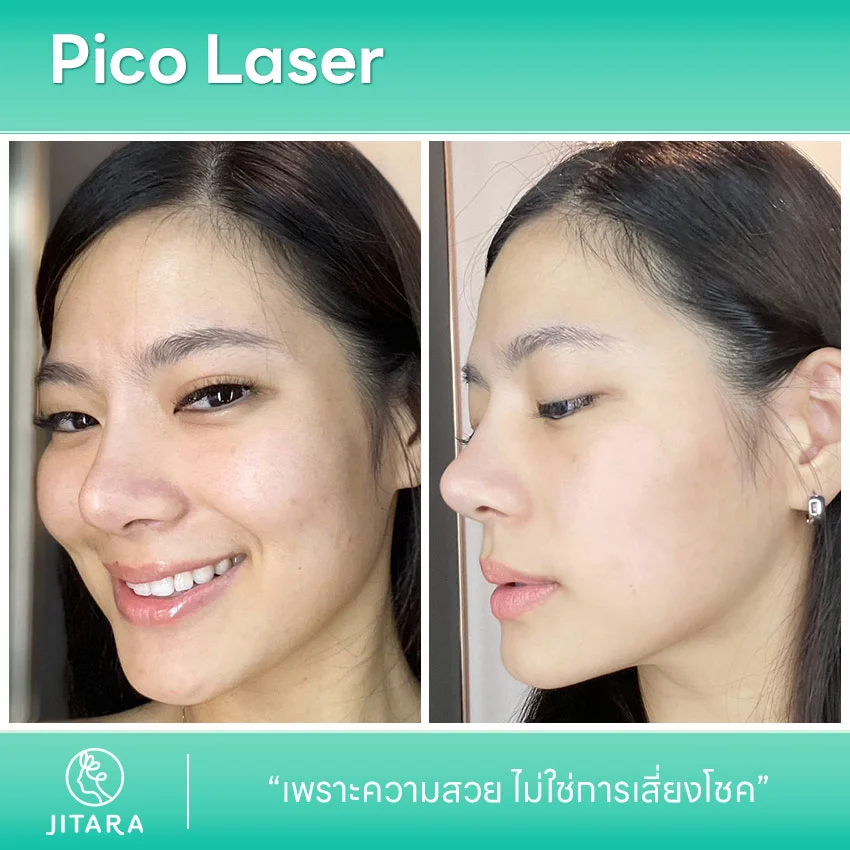 รีวิว Pico Laser