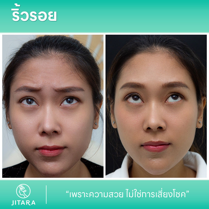 รีวิว รักษาริ้วรอย